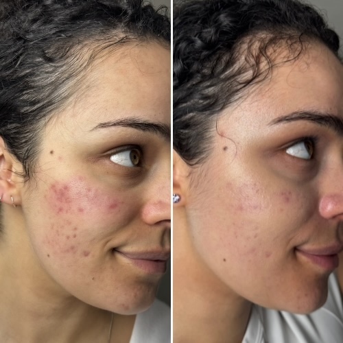 masque led avant apres masque led avant apres