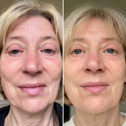 masque led currentbody avant apres masque led currentbody avant apres